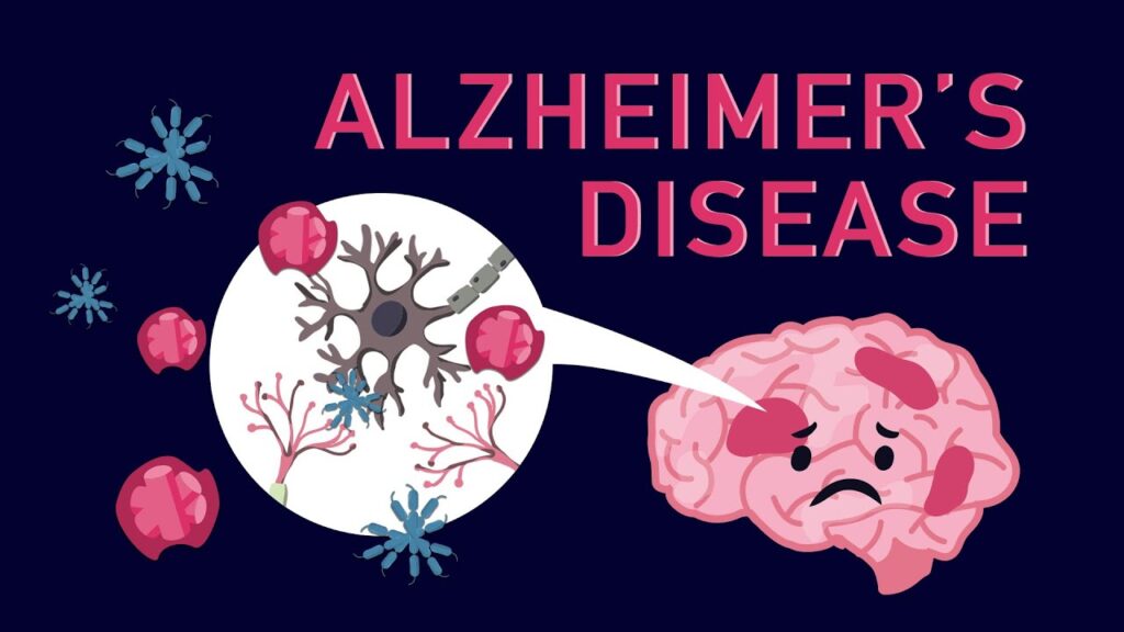 Alzheimer’s Disease is a leading cause of death