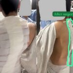 Complex Spinal Surgery Performed in Islamabad 4 complex spinal surgery - Complex Spinal Surgery Performed in Islamabad